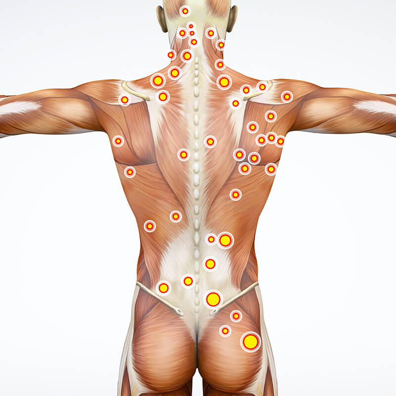 Dry-Needling ist eine Therapie für Triggerpunkte am menschlichen Körper